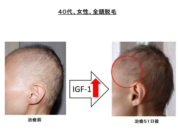 円形脱毛症　病院
